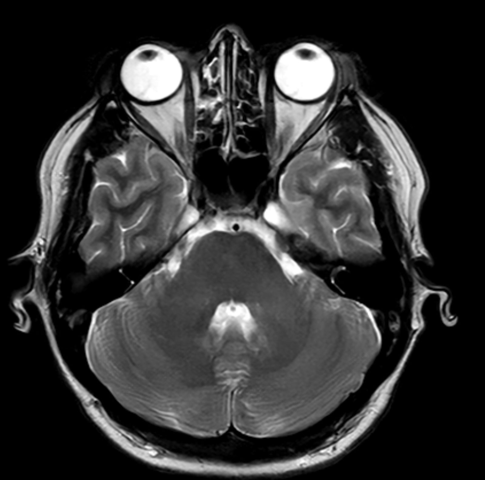 Obraz DICOM mózgu z rezonansu magnetycznego APERTA 1T – wysokopolowa diagnostyka neuroobrazowa Rzeszów