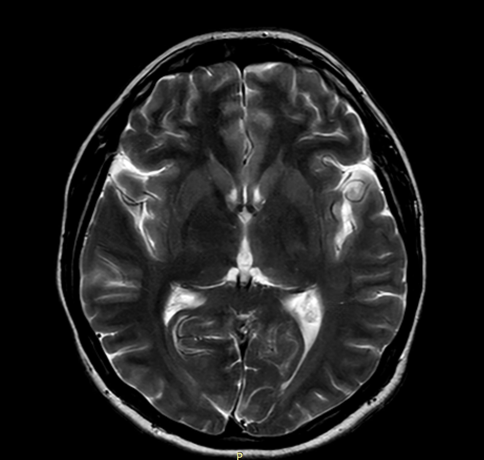 Obraz DICOM mózgu sekwencja T2 z otwartego rezonansu magnetycznego APERTA Rzeszów